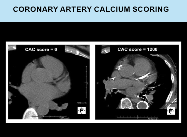 Coronary Artery Calcium Scoring