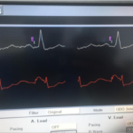 pacemaker implantation-2
