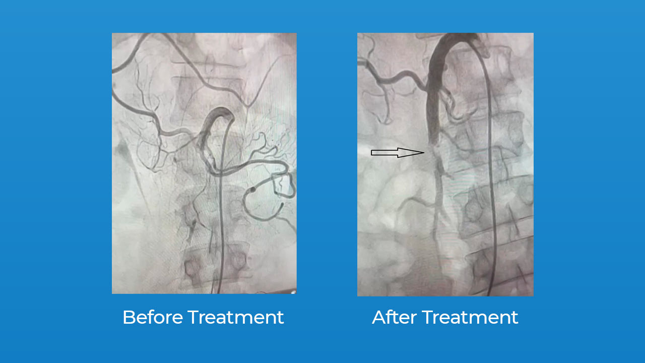 Catheter direct thrombolysis of occluded SMA Trust Multispeciality